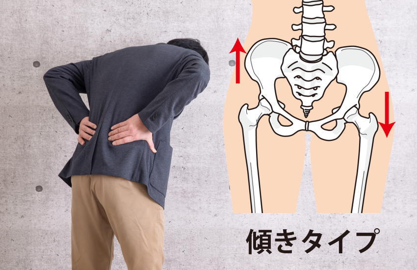骨盤の歪みが原因の腰痛